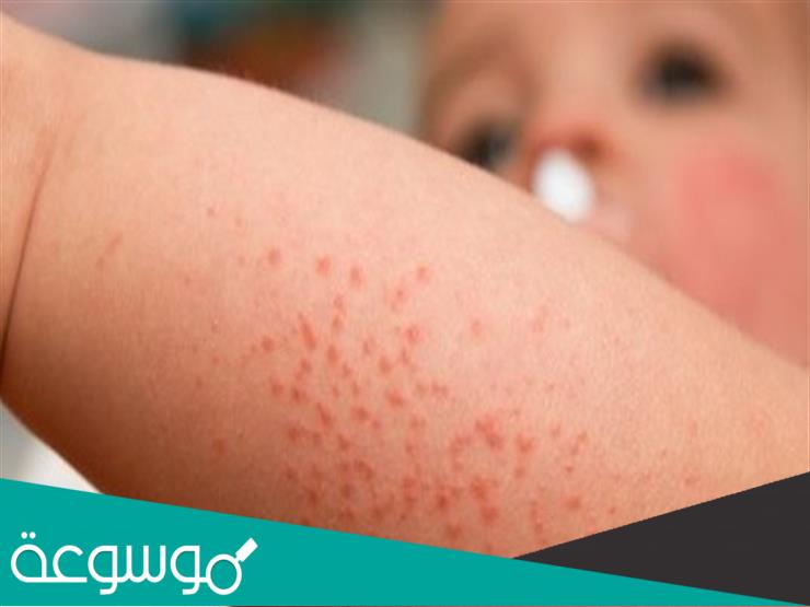 كيفية علاج الجرب بالطرق الطبيعية