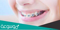 ما هي أنواع تقويم الأسنان وأسعاره ومدته