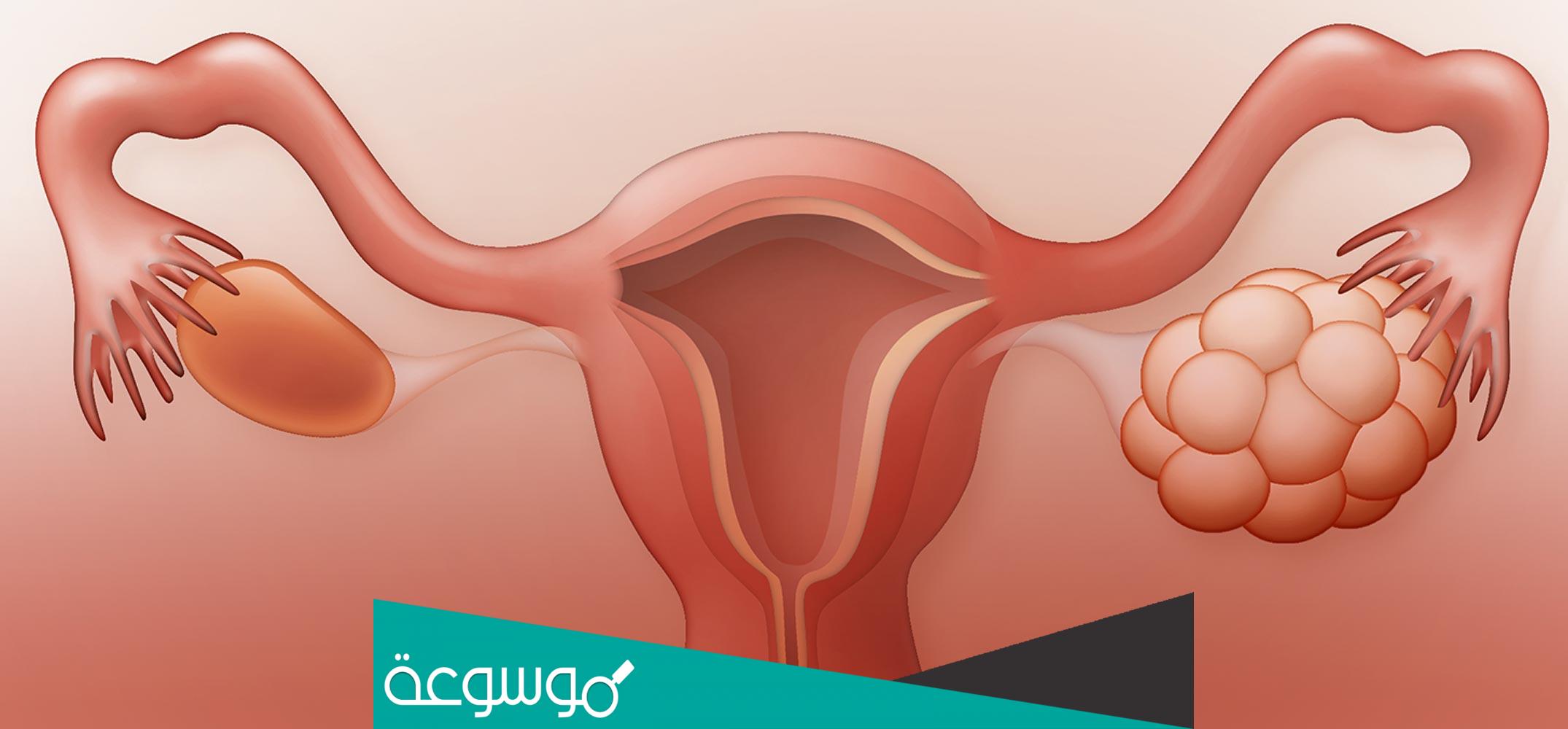 هل كيس شيكولاتة على المبيض يمنع الحمل