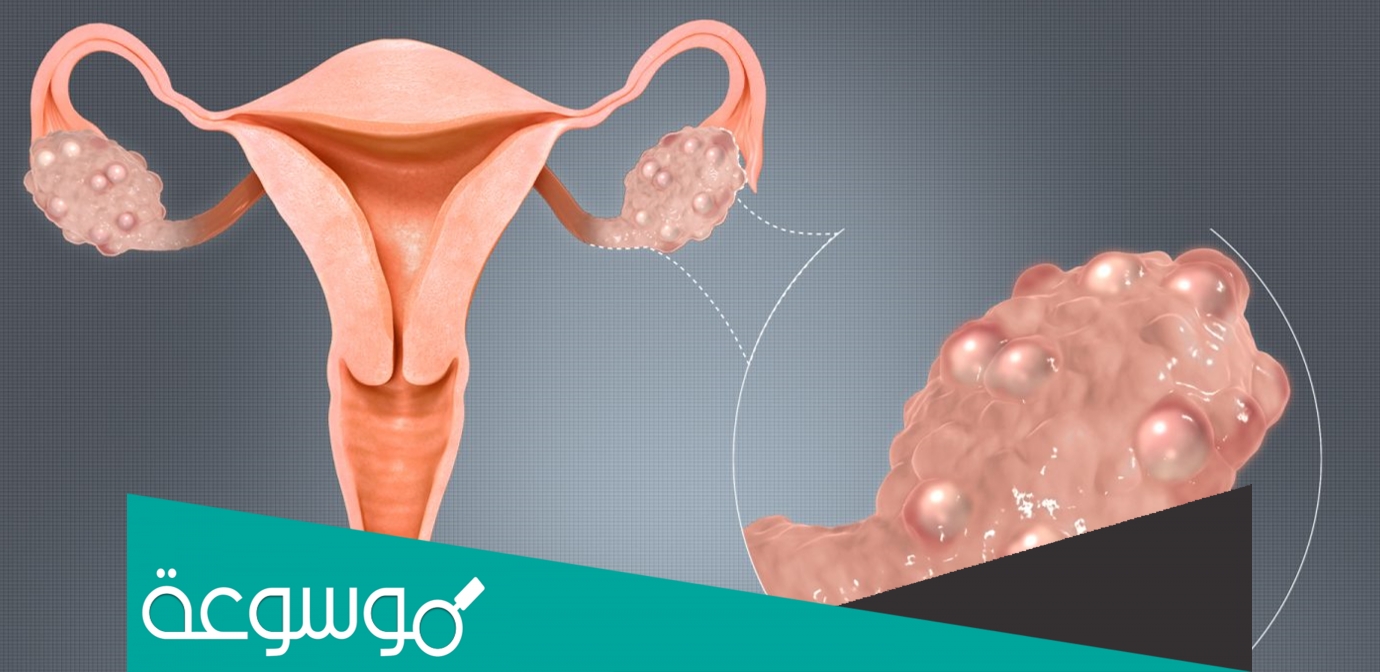 هل كيس يؤثر شيكولاتة على المبيض يمنع الحمل ؟