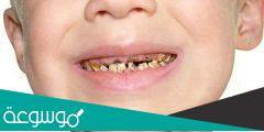 علاج تآكل الاسنان عند الأطفال مجرب ومضمون وآمن