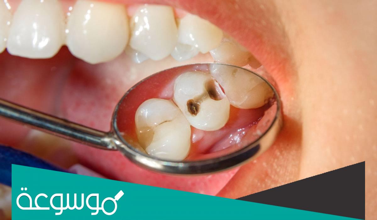 علاج الم الضرس المسوس بطريقة طبيعية وسهلة
