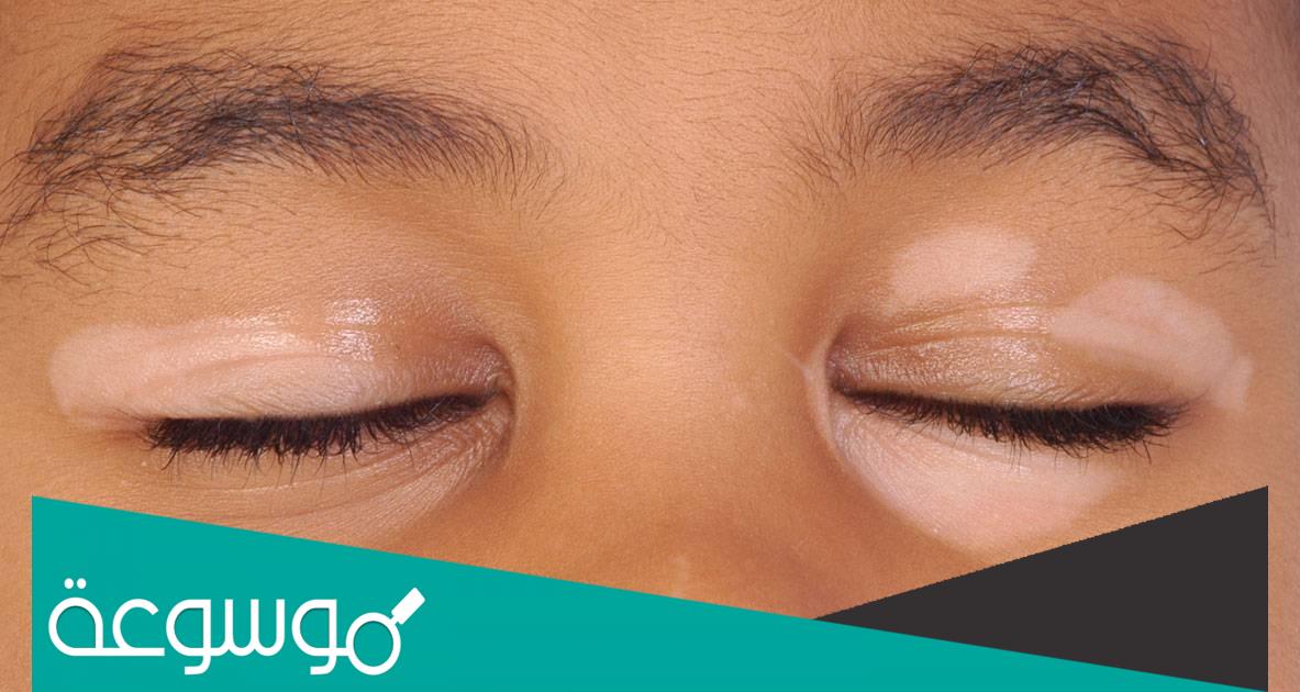 تفسير رؤية الإصابة بالبرص في المنام وتفسير البهاق في المنام