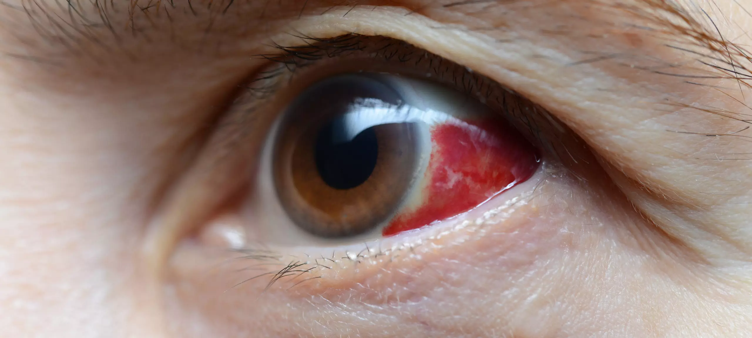 تفسير رؤية العين المصابة في المنام للفتاة