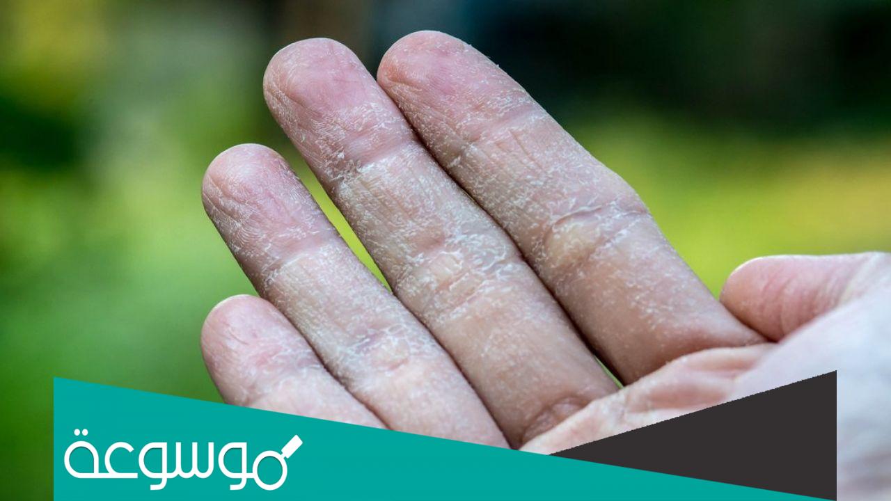 تفسير رؤية انه يقشر جلد كفة يده في المنام