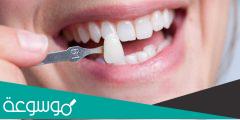 اضرار عدسات الاسنان ومميزاتها وأنواعها