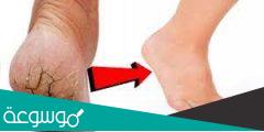 علاج تشقق القدمين مجرب