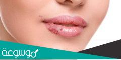 حساسية الشفاه وطريقة علاجها