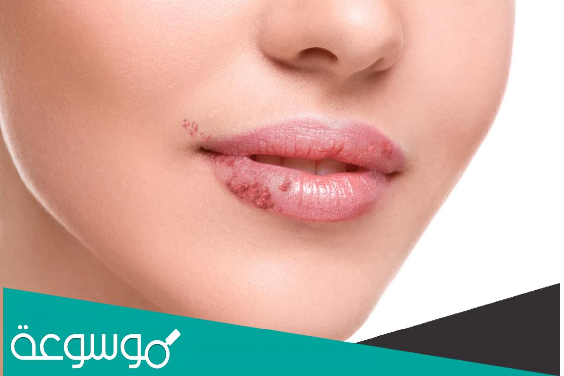 حساسية الشفاه وطريقة علاجها