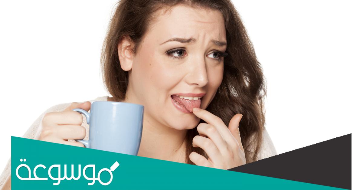 طرق منزلية لعلاج حرق اللسان