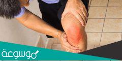 عشرة وصفات طبيعية لعلاج التهاب المفاصل الصدفي