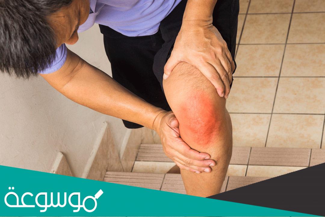 عشرة وصفات طبيعية لعلاج التهاب المفاصل الصدفي