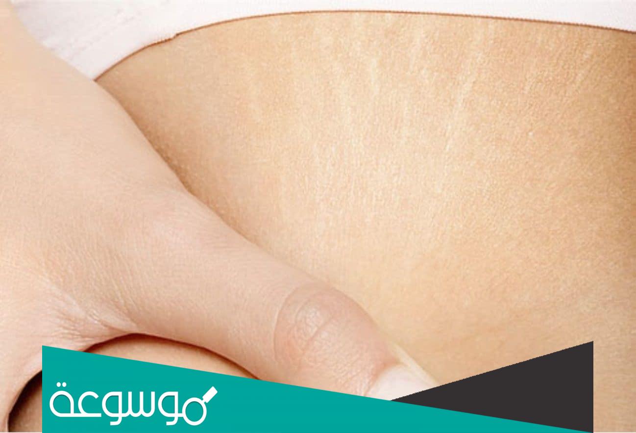 علاج الخطوط وترهلات بالجسم بطريقة طبيعية