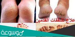 علاج تشققات القدم