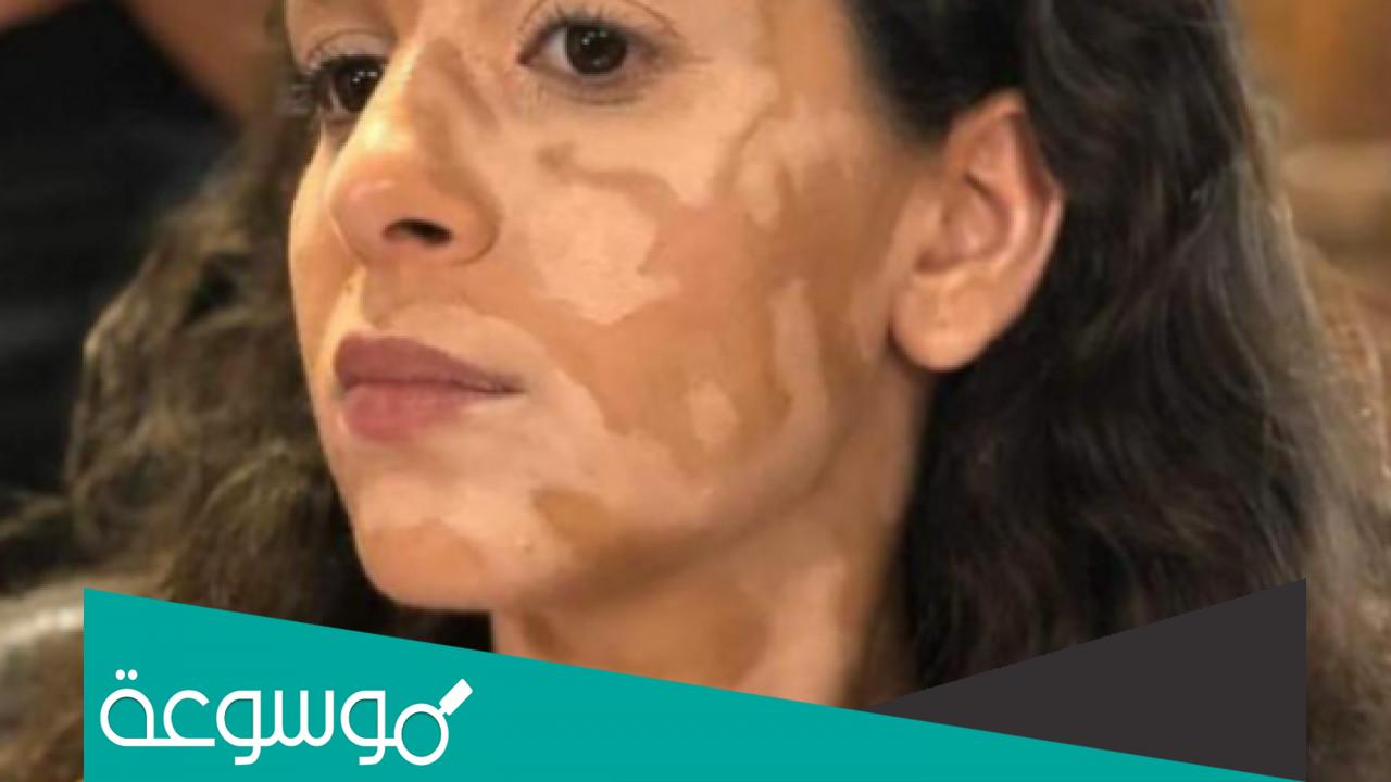 تفسير رؤية البهاق في المنام تفسير ابن سيرين