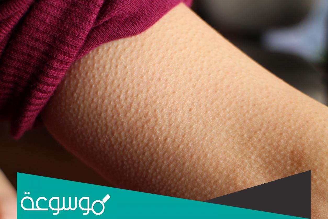 هل القشعريرة من اعراض العين