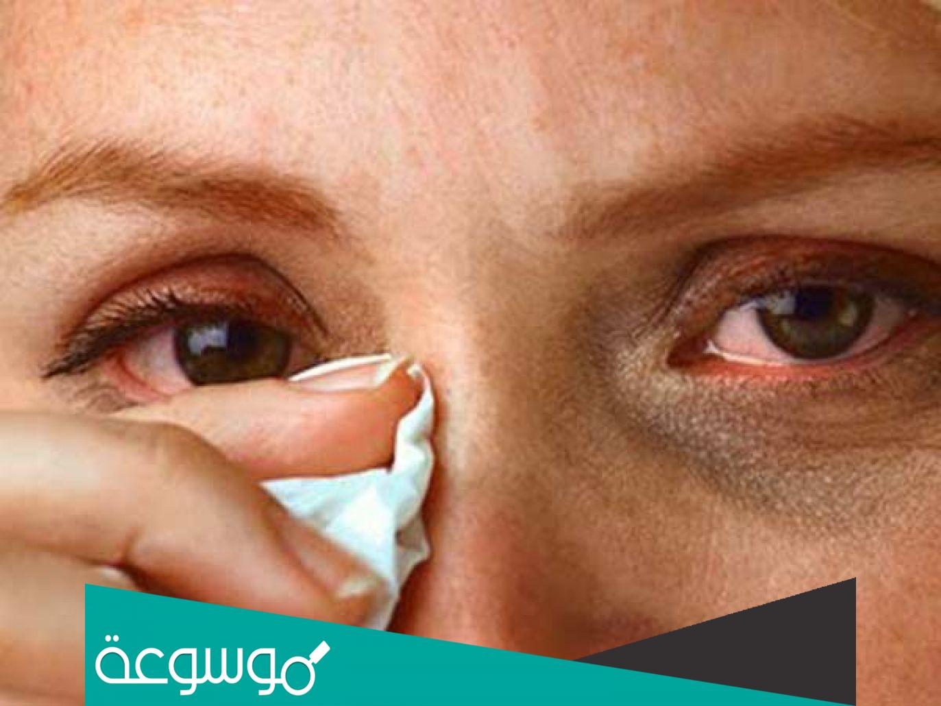 ما هي أسباب واعراض وطرق علاج الرمد الربيعي