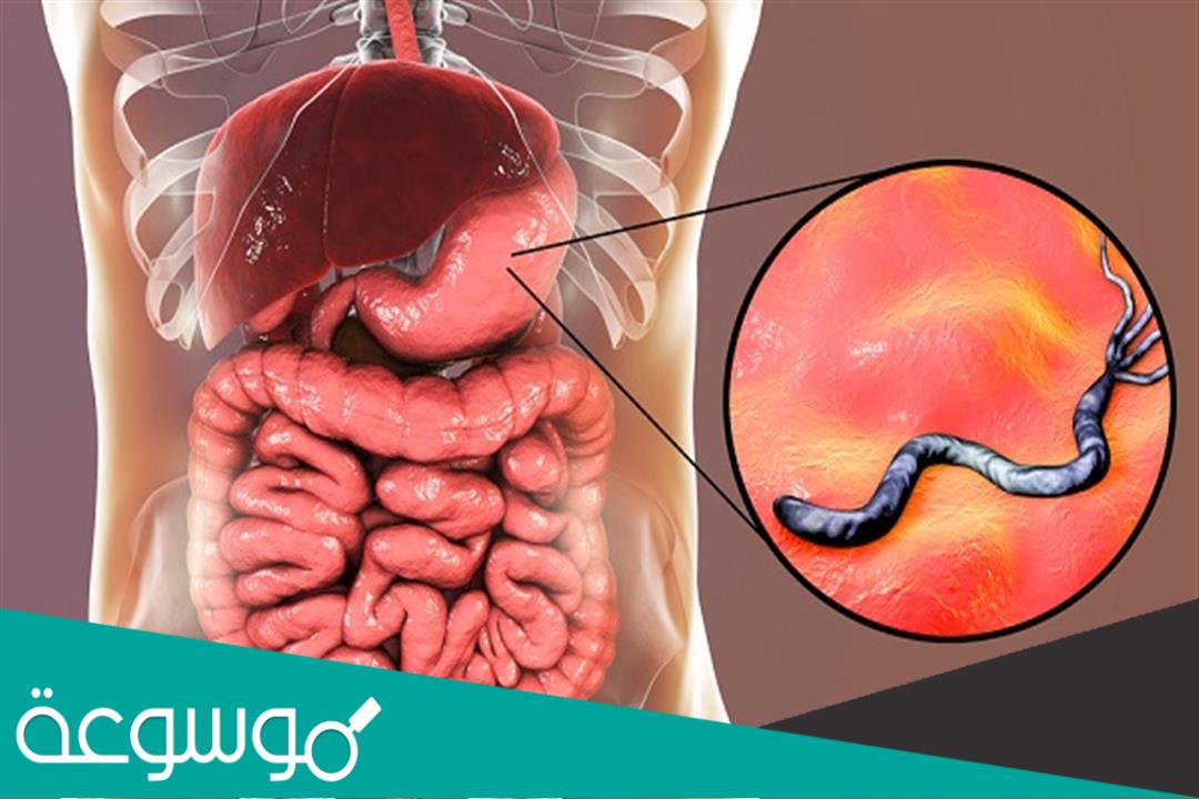 ما هي أعراض جرثومة المعدة وطرق علاجها بالأعشاب الطبيعية