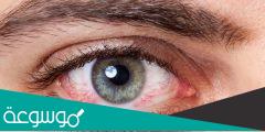 قطرة لاحمرار العين وما أسباب الاحمرار علاجه