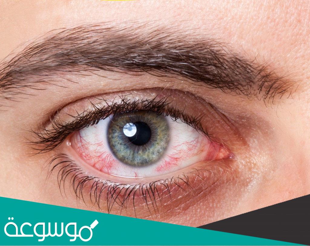 قطرة لاحمرار العين وما أسباب الاحمرار علاجه