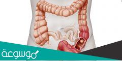 علاج القولون العصبي والغازات وأسباب الإصابة به