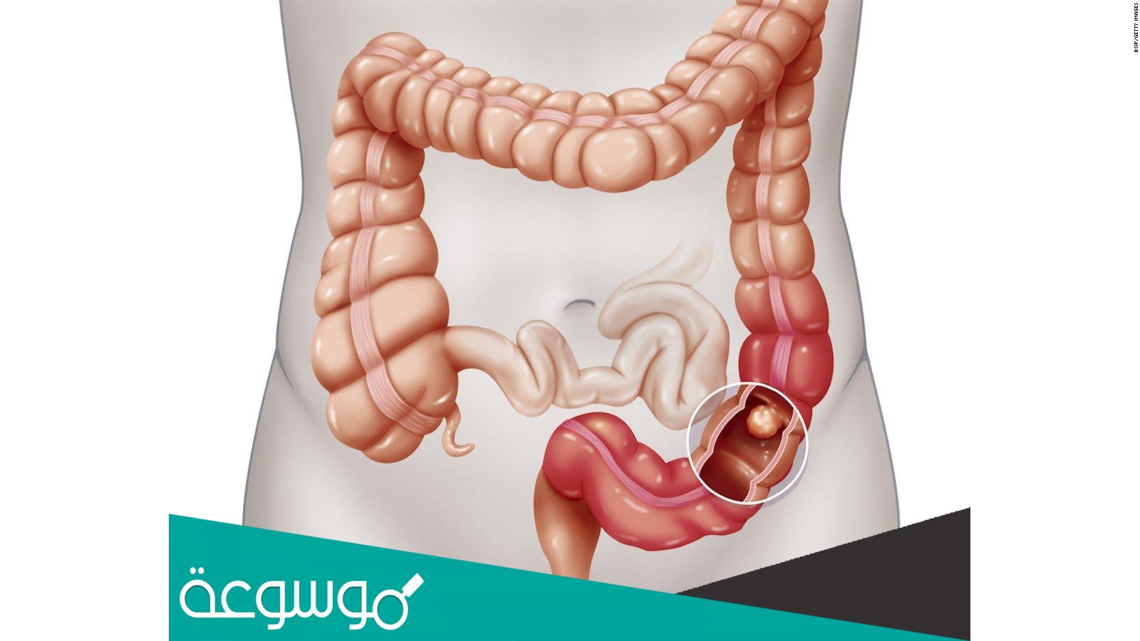 علاج القولون العصبي والغازات وأسباب الإصابة به