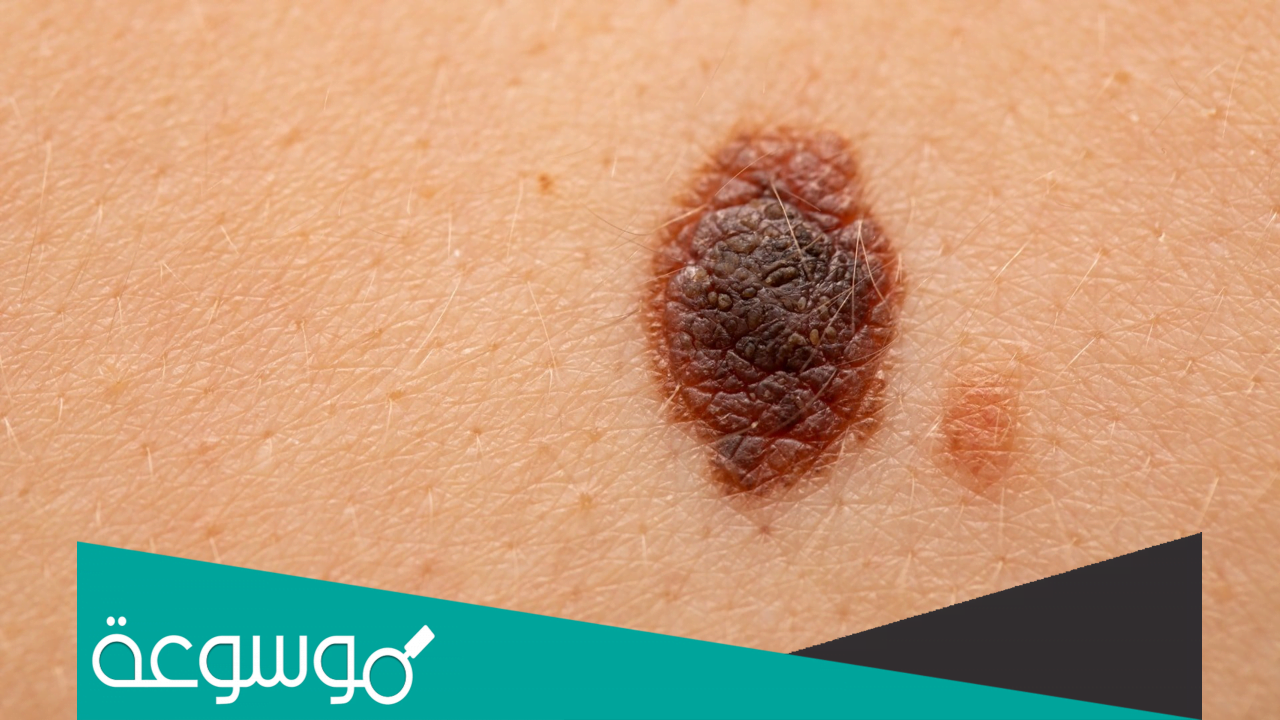 أعراض سرطان الجلد في بدايته وأهم الطرق العلاجية