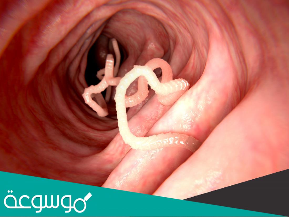 ديدان البطن وأنواعها وأسبابها وطرق علاجها