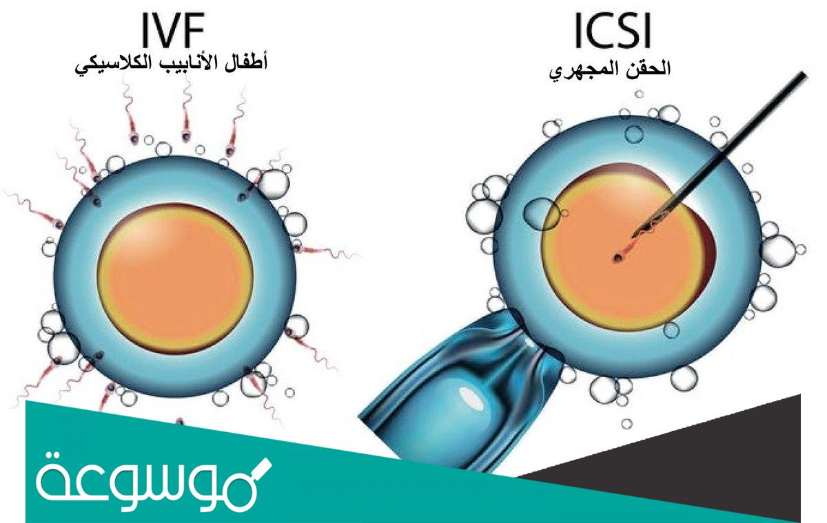 ما طريقة استخراج البويضات للحقن المجهري طبيا