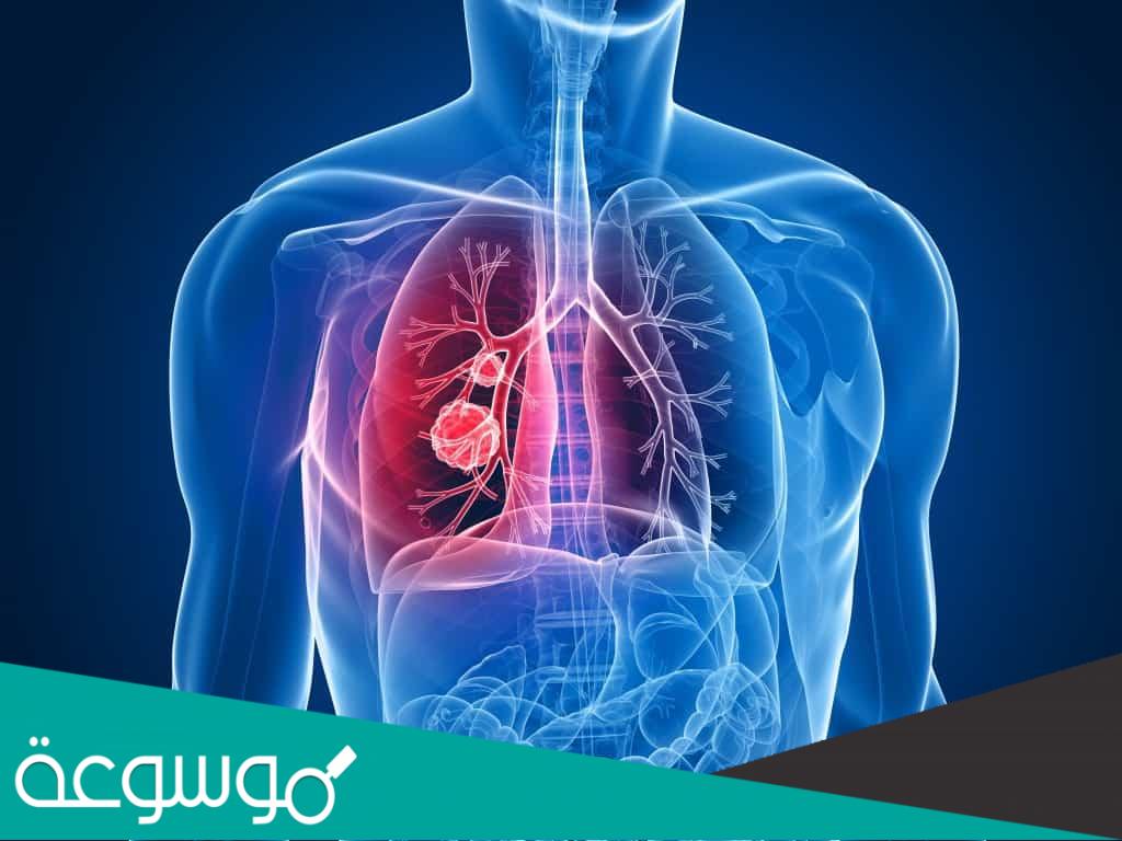 اعراض وعلاج الإلتهاب الرئوي الحاد عند كبار السن وأعراض الإلتهاب