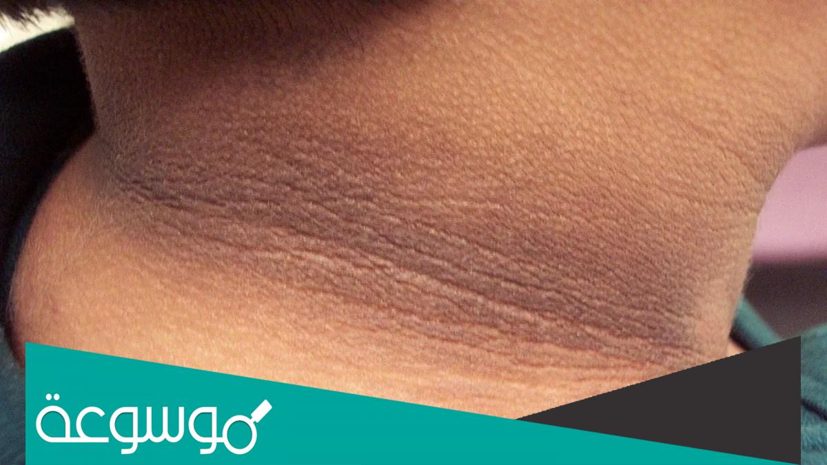 تجارب علاج سواد الرقبة للرجال وأسباب المرض