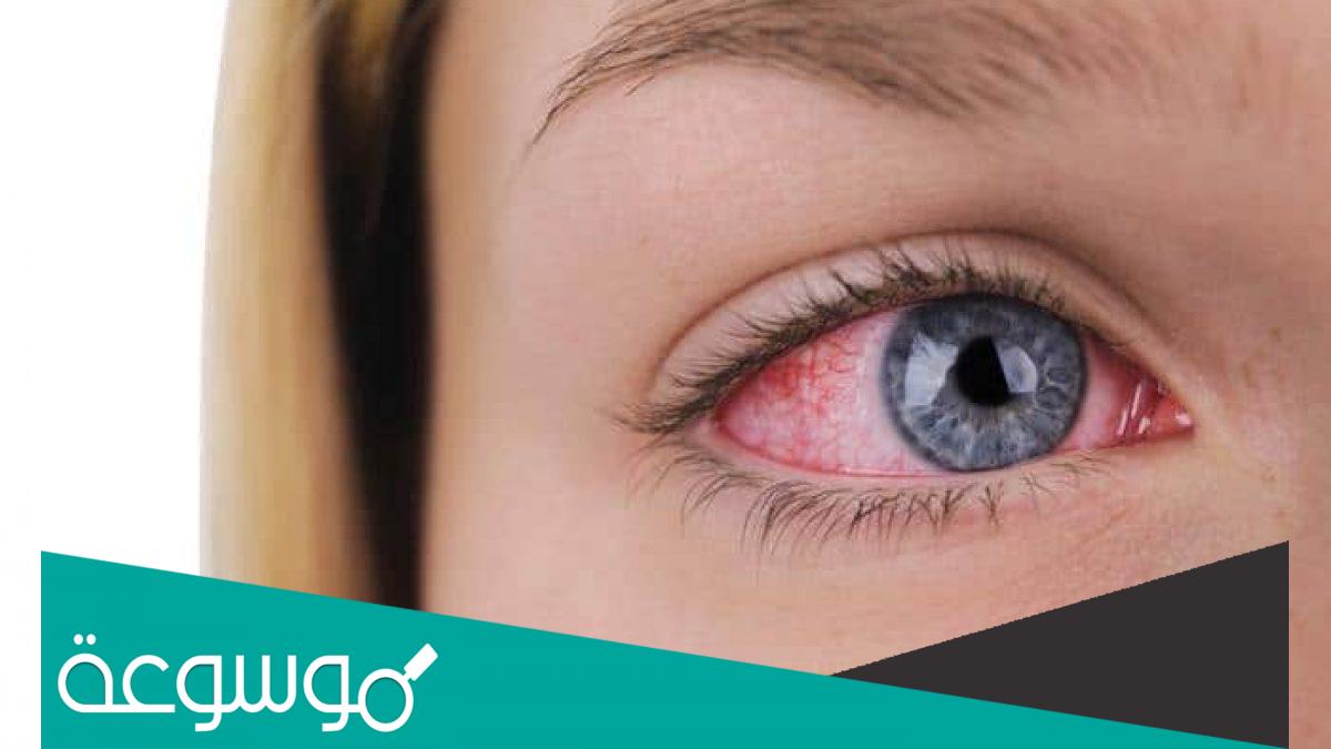 علاج نهائي لجفاف العين وأسباب الجفاف
