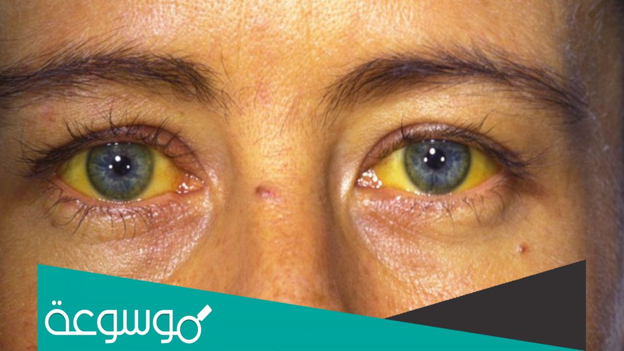 أسباب اليرقان واعراضه وطرق علاجه