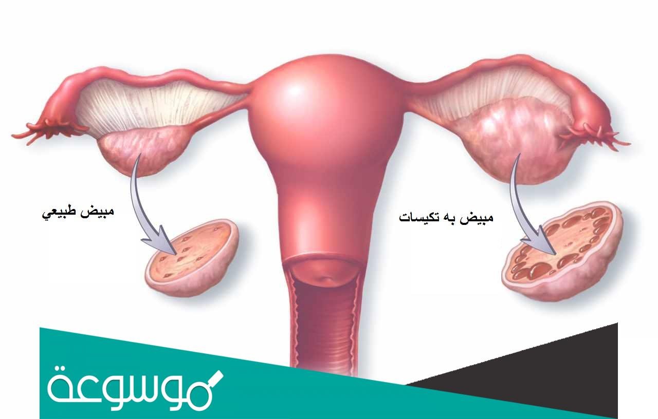 هل يحدث حمل مع تكيس المبايض