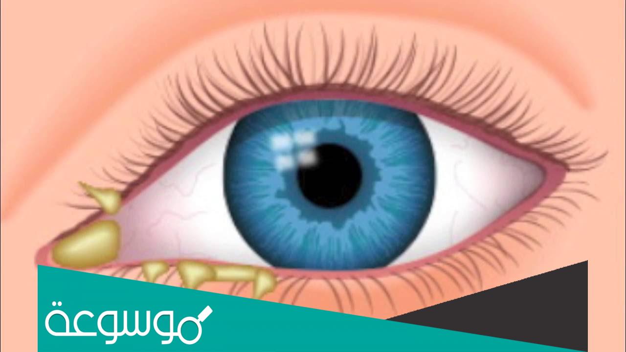 علاج افرازات العين الصفراء وأسباب هذه الإفرازات