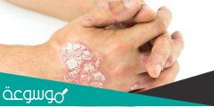 أسباب الصدفية في الجلد و طرق علاجها