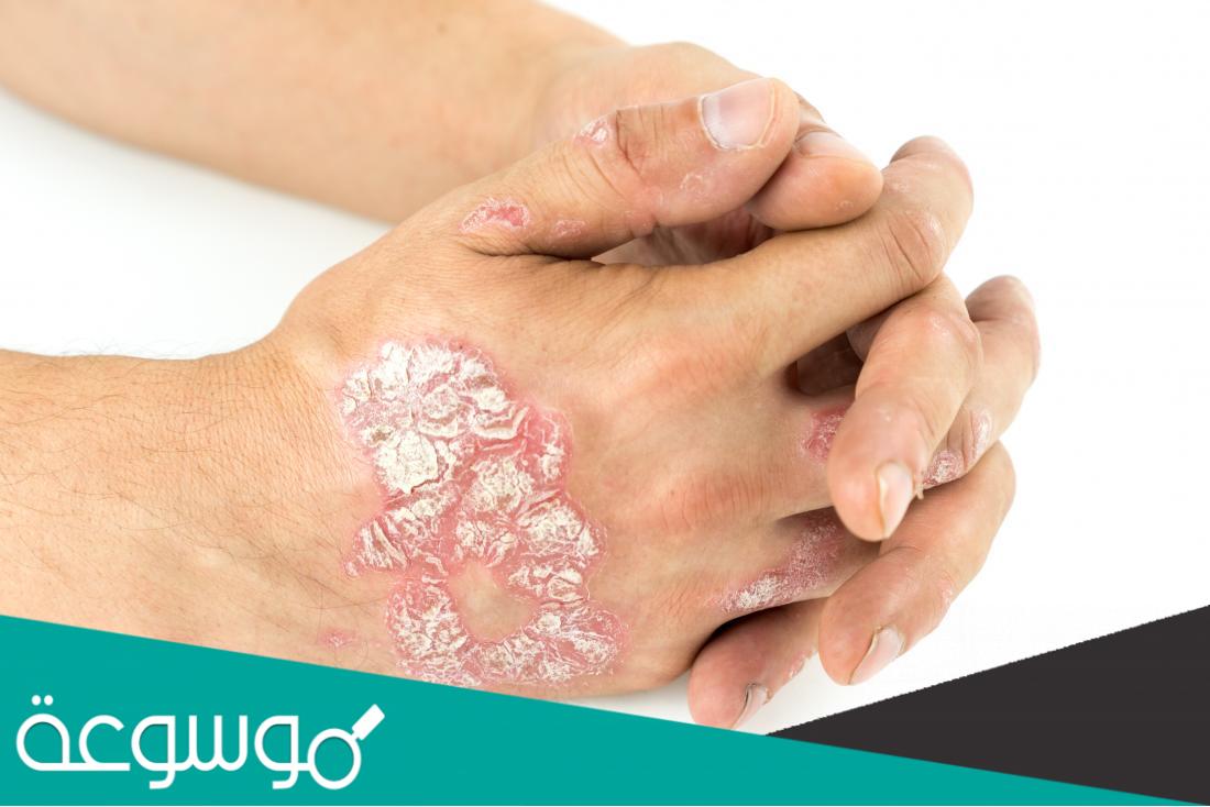 أسباب الصدفية في الجلد و طرق علاجها