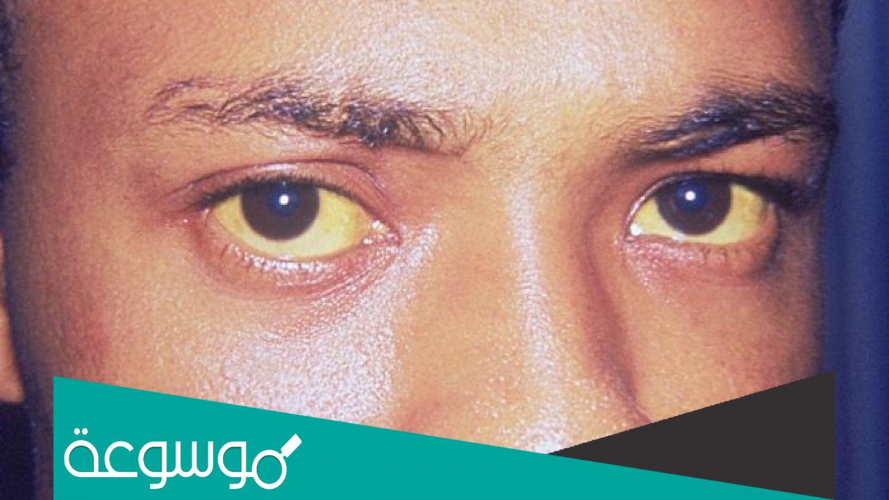 اعراض مرض اليرقان ابو صفار وأسبابه وطرق علاجه