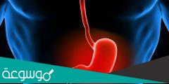 أعراض التهاب المريء وأسبابه وطرق علاجه