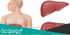 التهاب الكبد ما الأسباب والأعراض وطرق العلاج