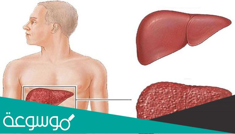 التهاب الكبد ما الأسباب والأعراض وطرق العلاج