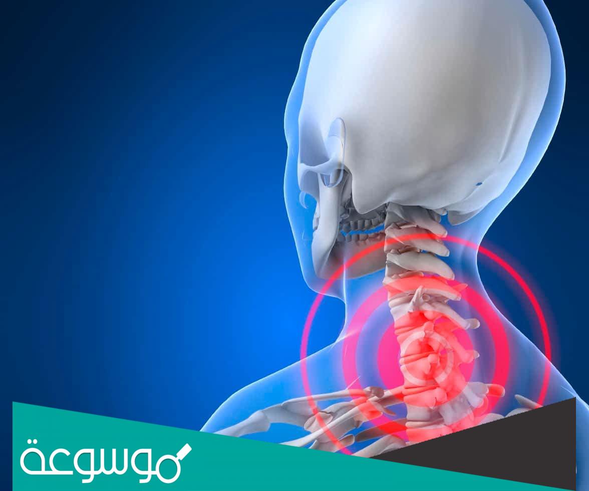 ما علاج التواء الرقبة بعد النوم وما أسباب الإلتواء