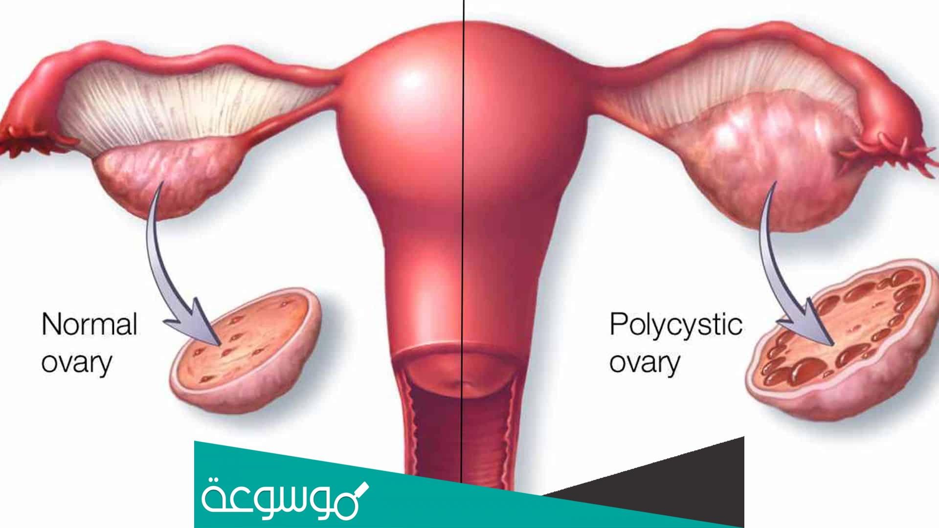 ماهي أعراض سرطان الرحم والمبايض وأسباب الإصابة