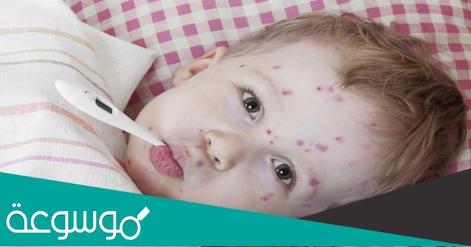 كيفية علاج الجديري المائي بسرعة طبيعيا