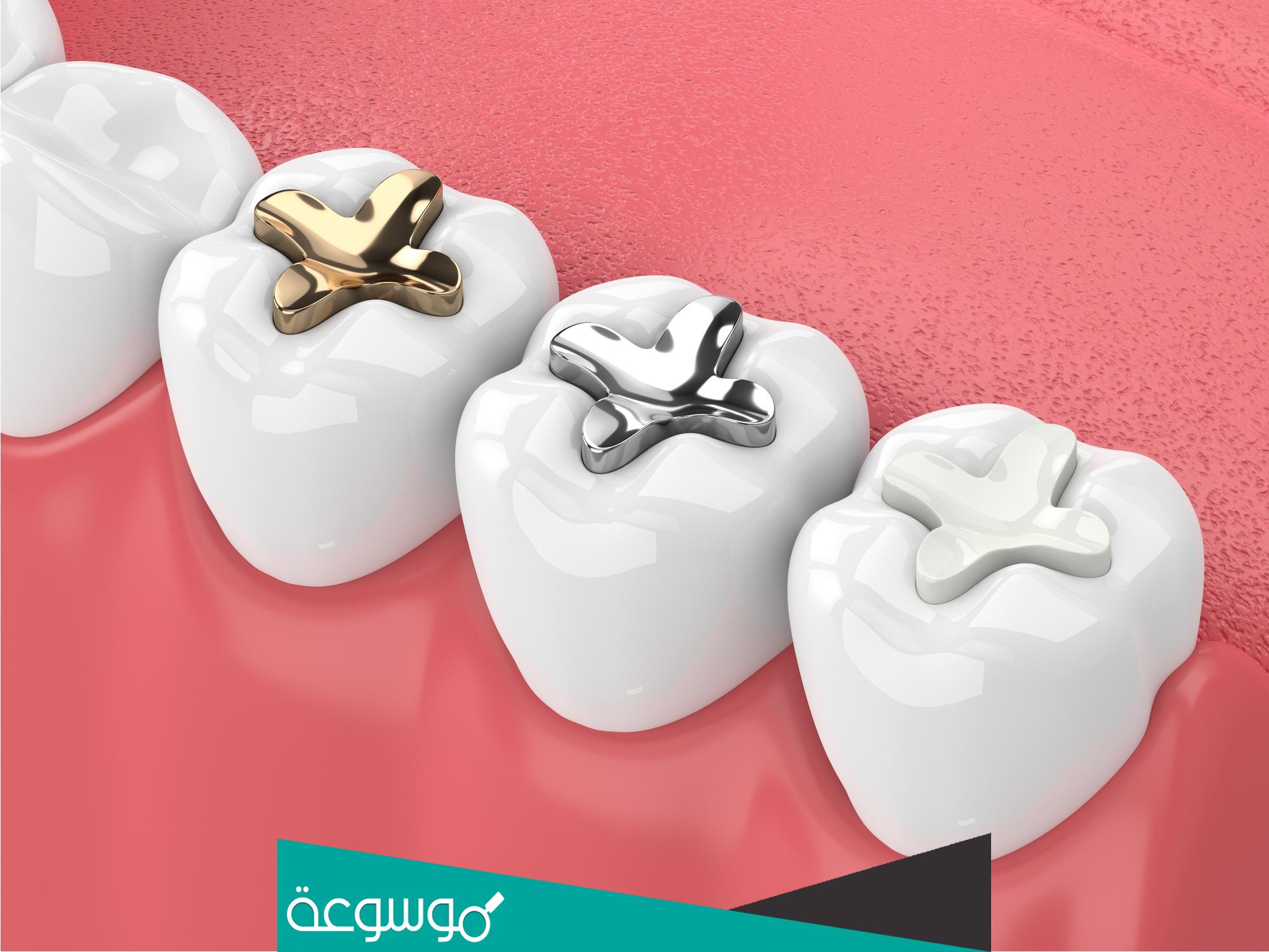 ما هي أفضل أنواع حشو الأسنان والاحتياطات عند استخدامها