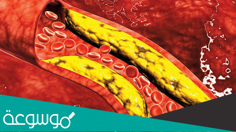 دواء بالأعشاب cholesterol لخفض الكوليسترول في الدم