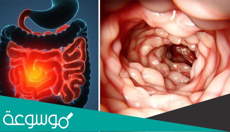 معلومات عن مرض الكرونز