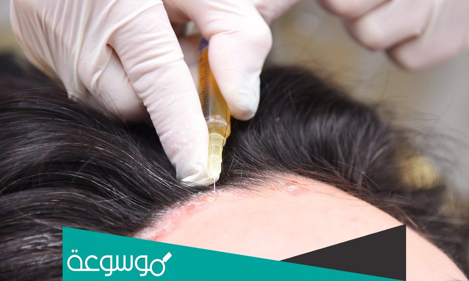 كيفية علاج الصدفية بالأعشاب الطبيعية