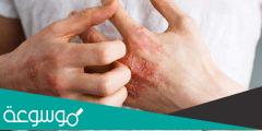 تجارب علاج الاكزيما في اليد والقدمين