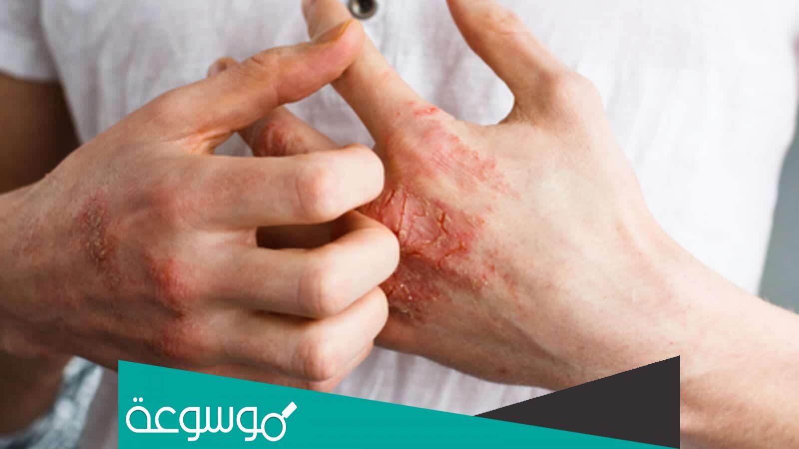 تجارب علاج الاكزيما في اليد والقدمين
